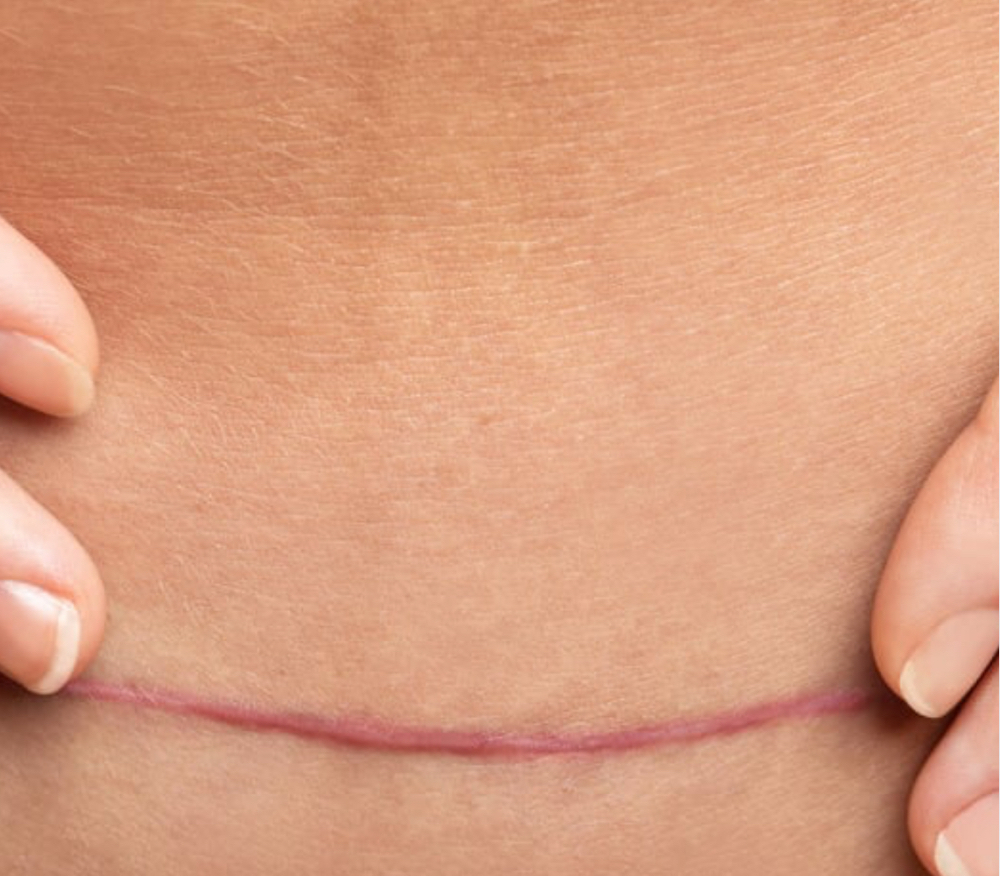 Scar Revisions