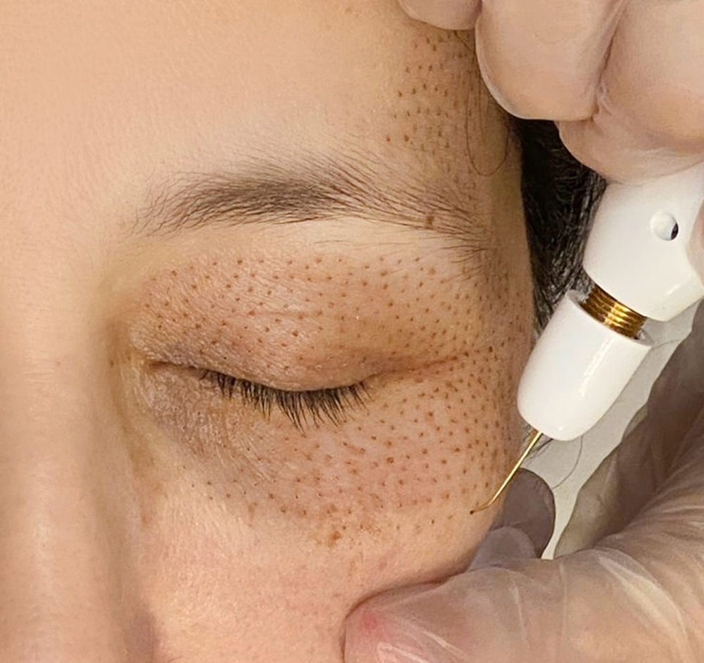 Fibroblast Skin Tightening
