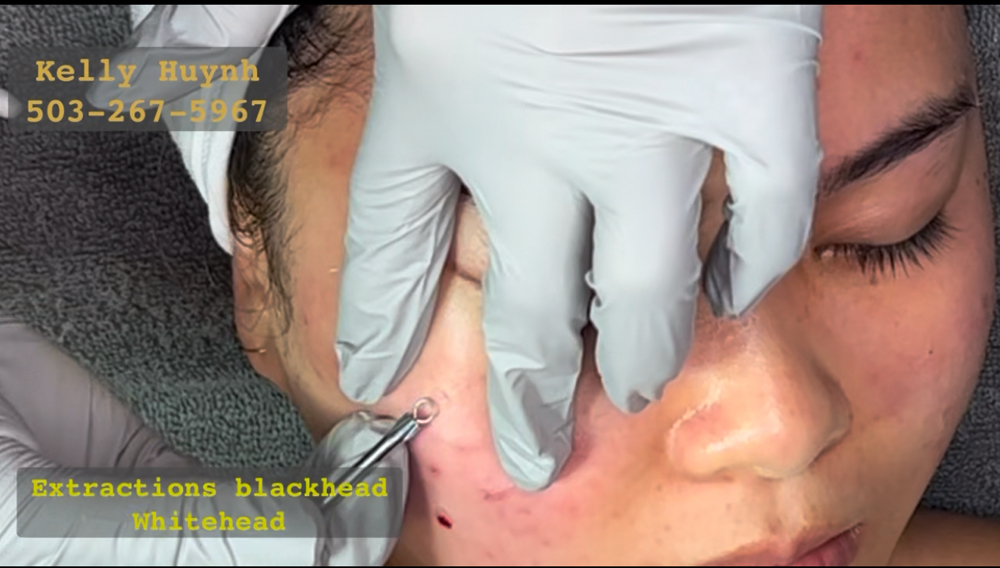 Acne facial treatment