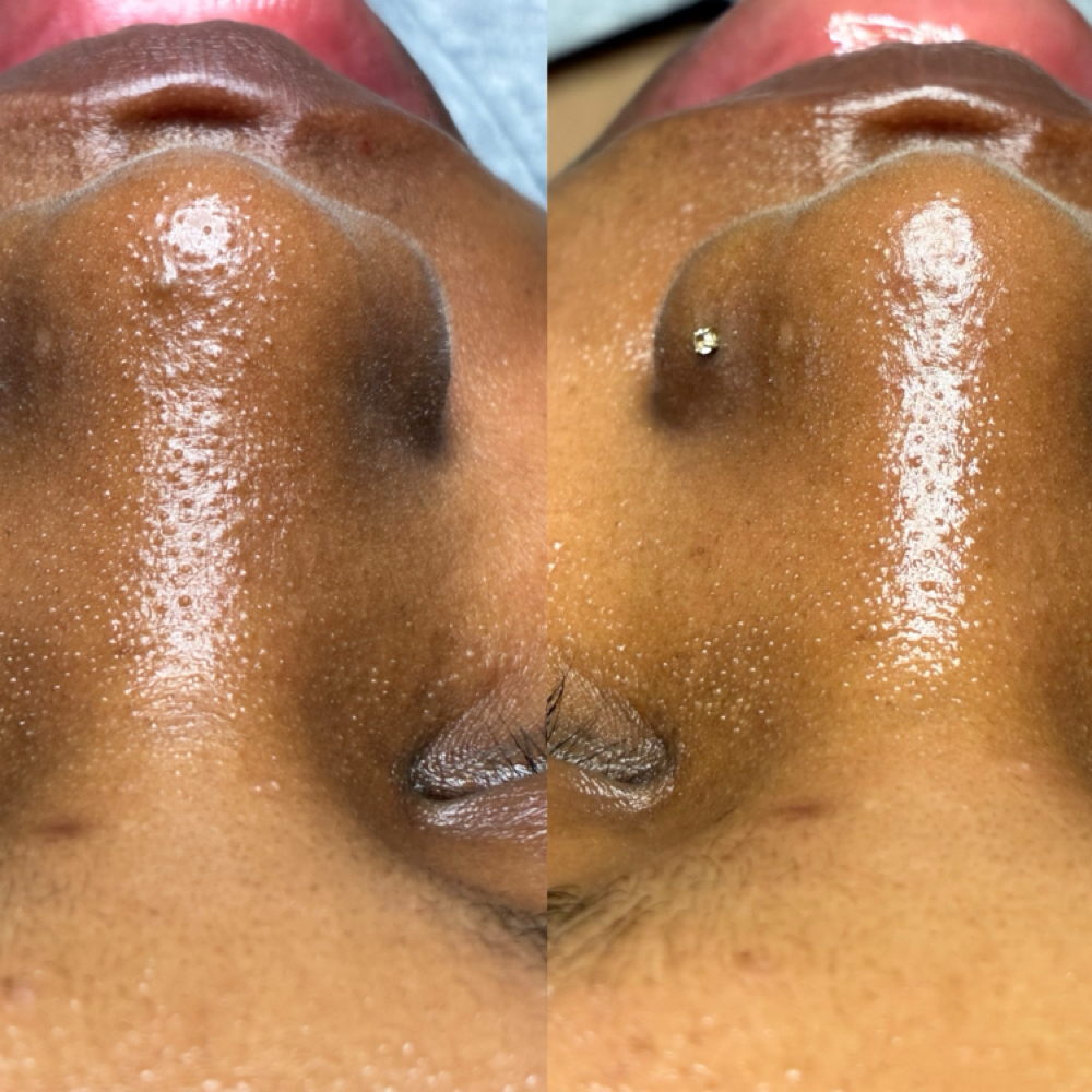 VI Peel + Peptides Package 2 at Oasiah Aesthetics in New York, NY