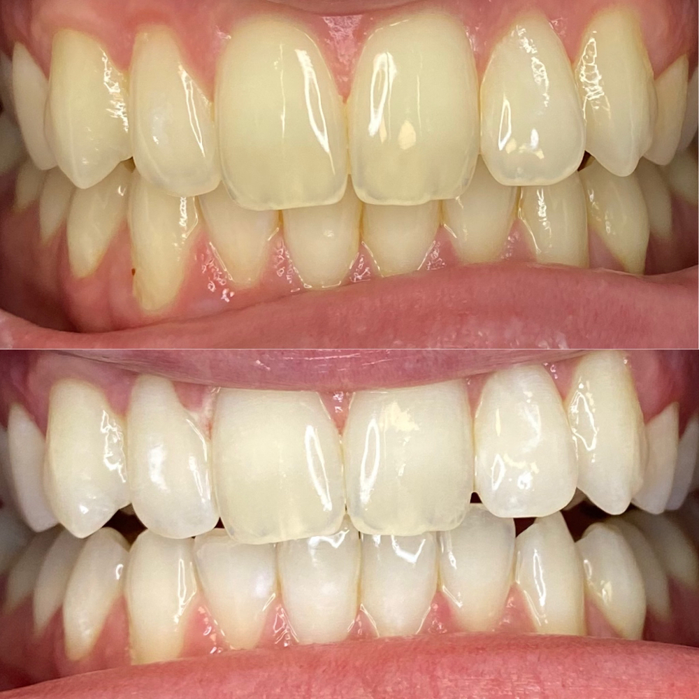 30 Minute Teeth Whitening