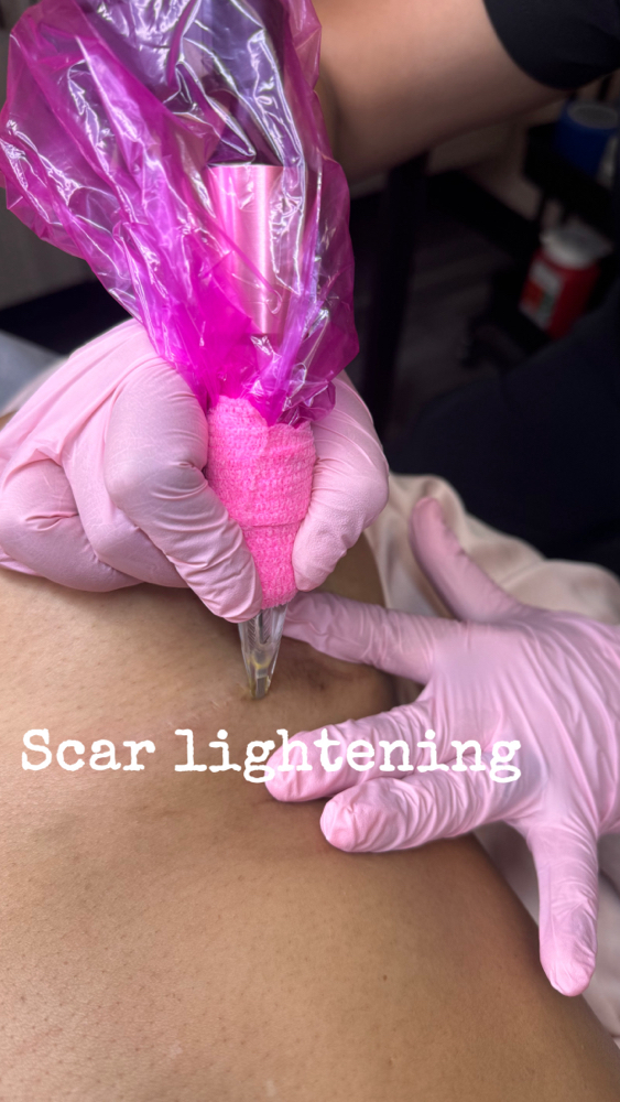 Scar Resurfacing