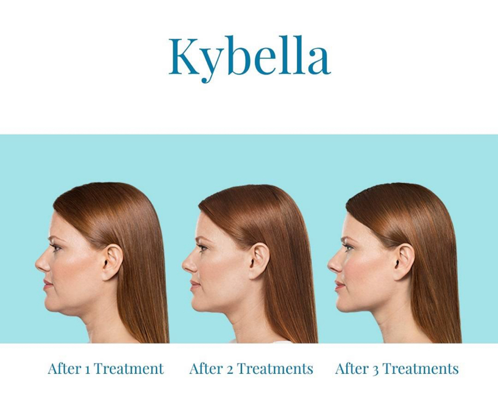 Kybella