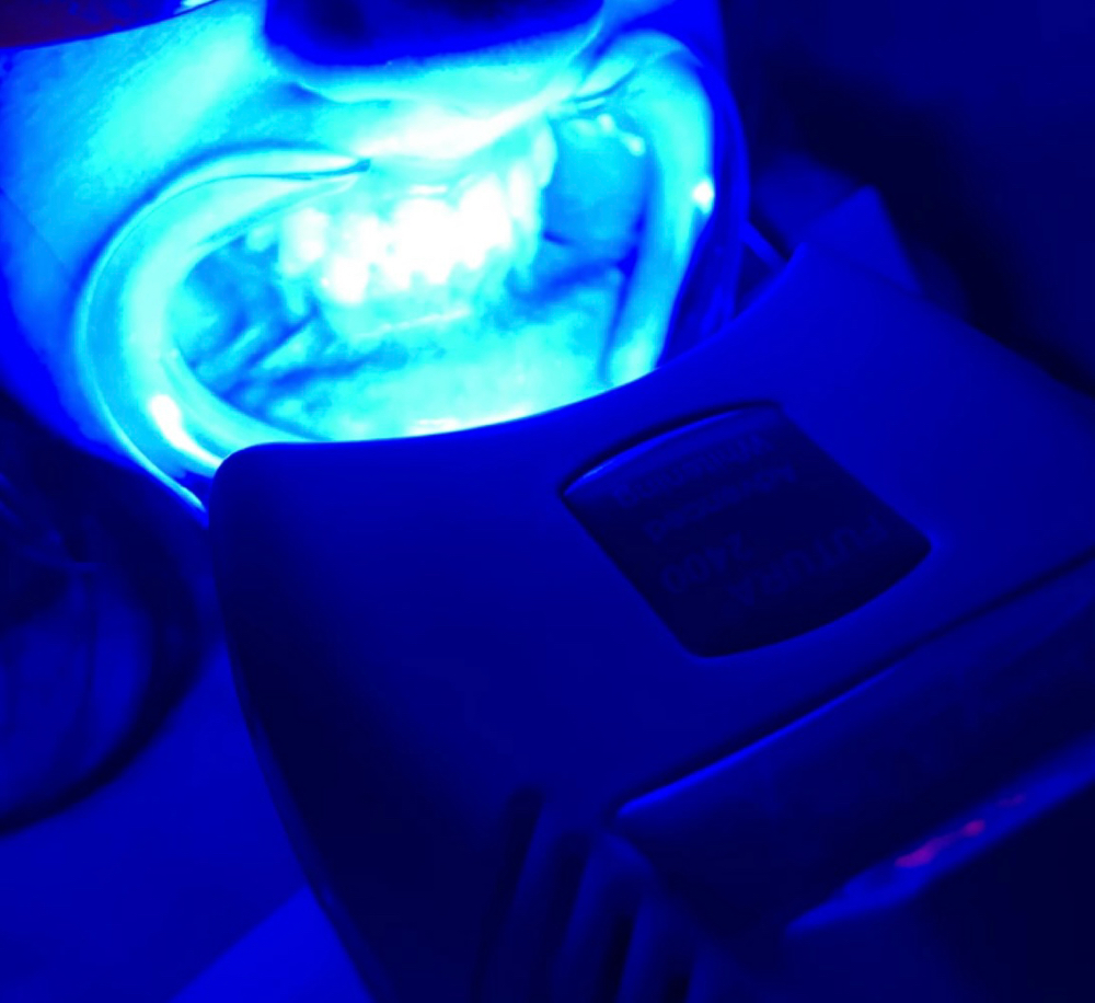 Teeth Whitening at Glowup by Kristine in Visalia, CA