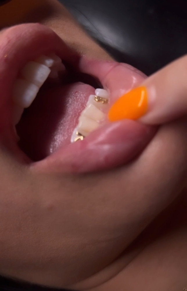 Gold Tooth Gem