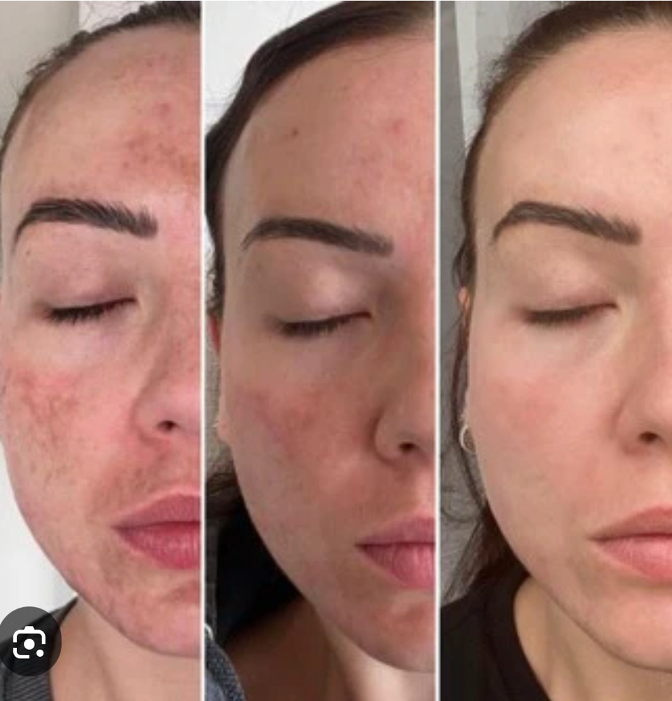 PCA Skin Pigment Correct Peel at Skin By Shelly in Port Washington, WI