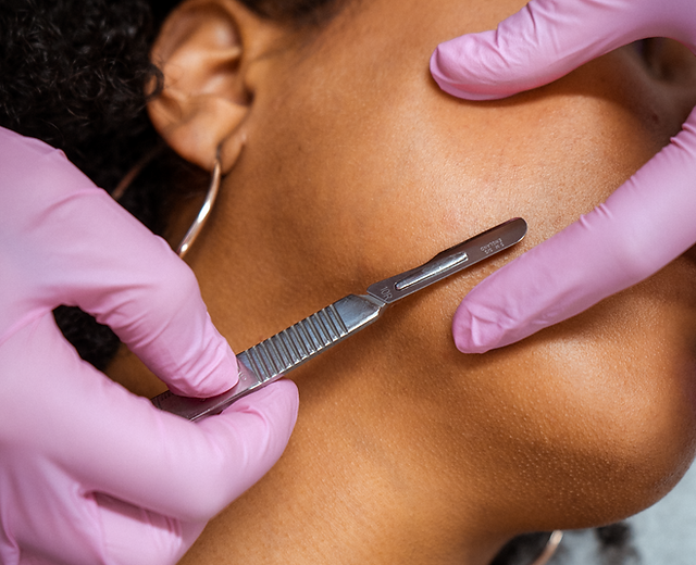 Dermaplaning