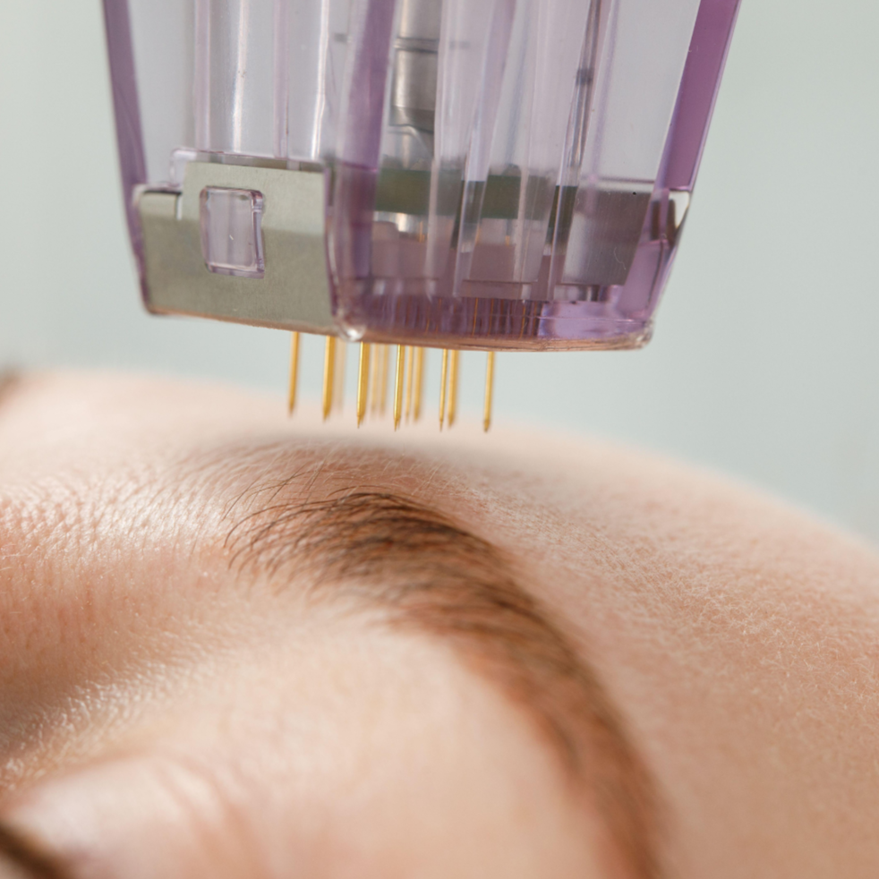 MICRONEEDLING at Here She Glows Spa in Agoura Hills, CA