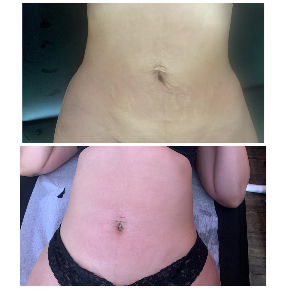 Body Contouring