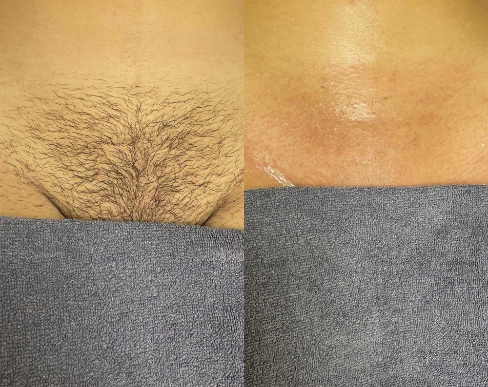 Brazilian Wax(female)