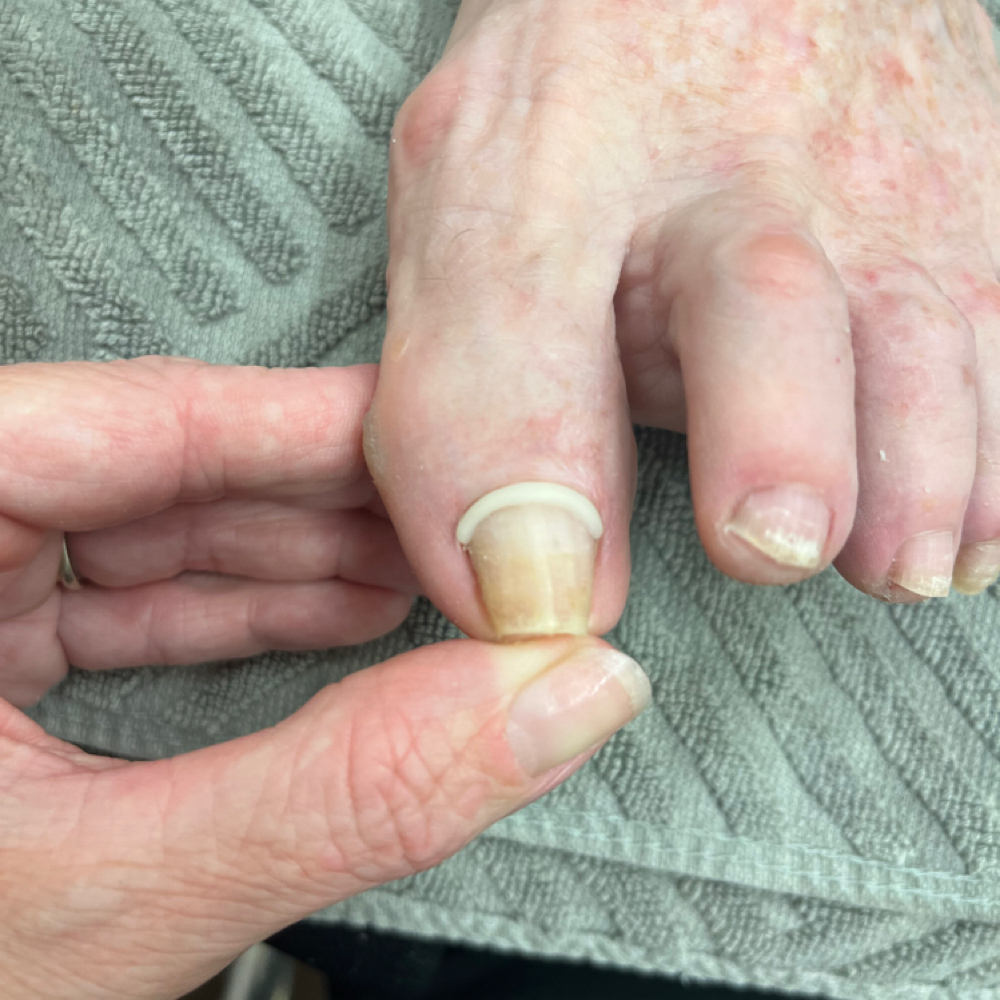 Signature Onyfix® Correction Band at Hand Crafted Nails in Coeur D Alene, ID