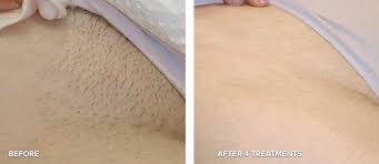 Hair Reduction - Bikini Line at Elegant Esthetics By Jozlyn in Lamar, CO