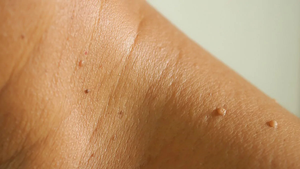 Milia/Skin Tag Removal