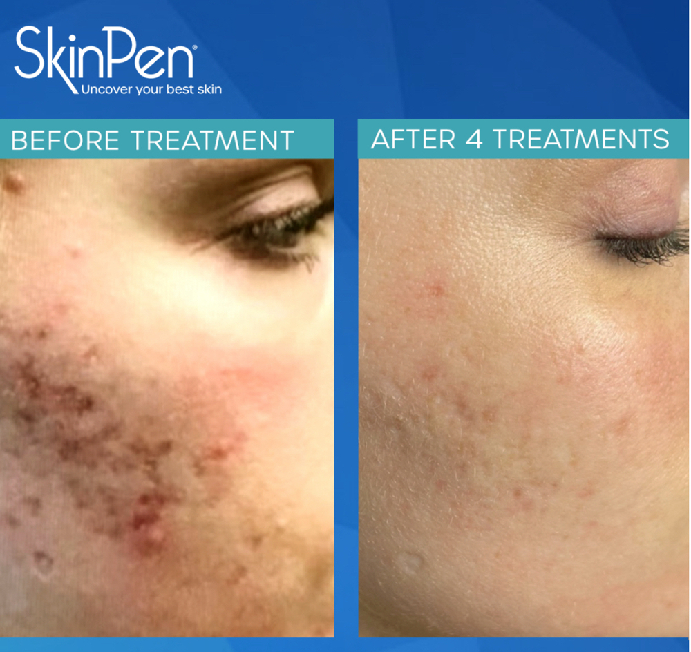 Skin Pen Microneedling