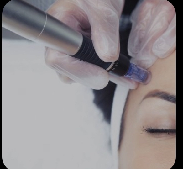 Microneedling