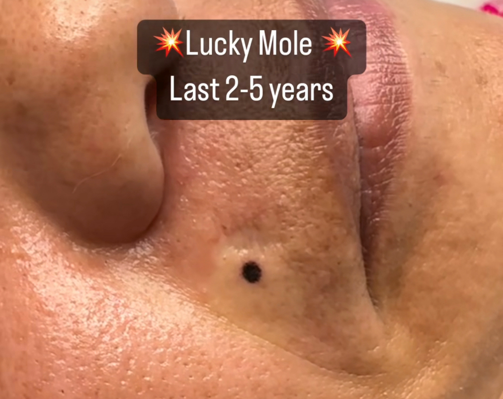 Mole Beauty Mark