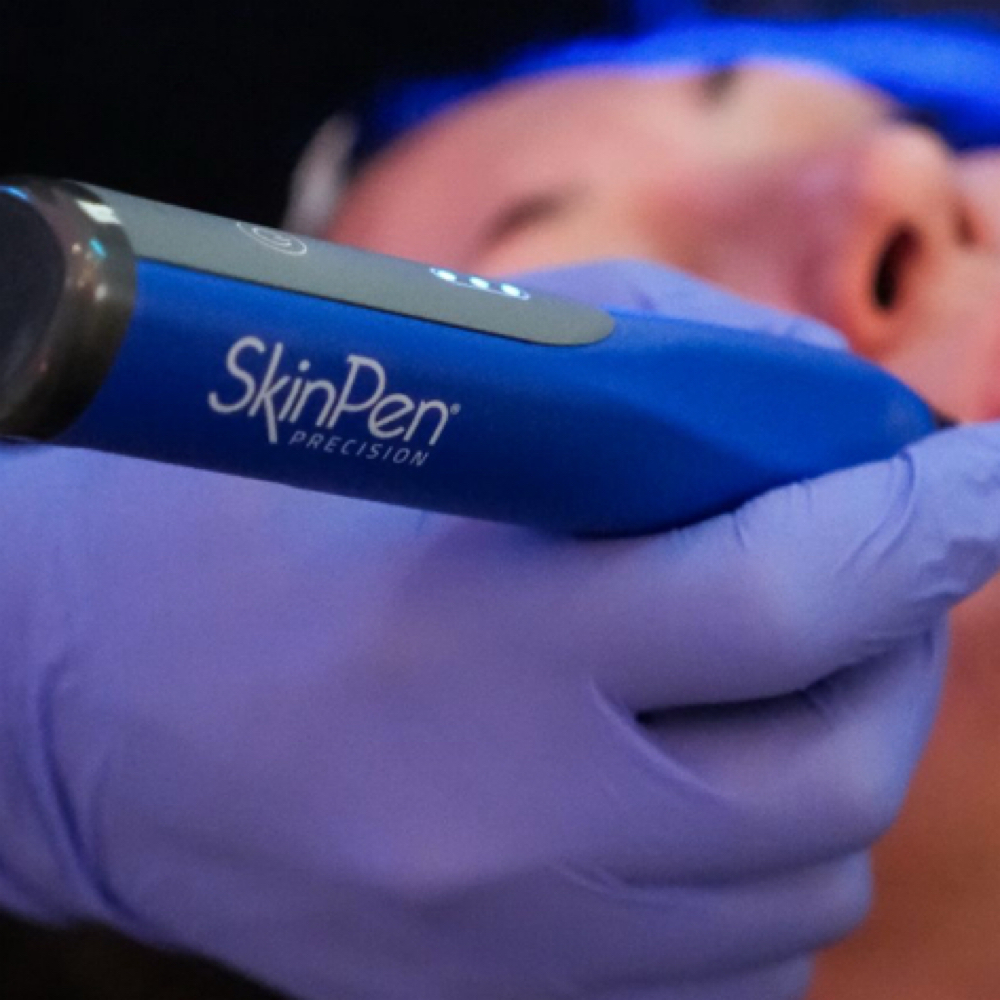 SkinPen Microneedling pkg 3 at NuSkin Beauty Bar in Avondale, AZ