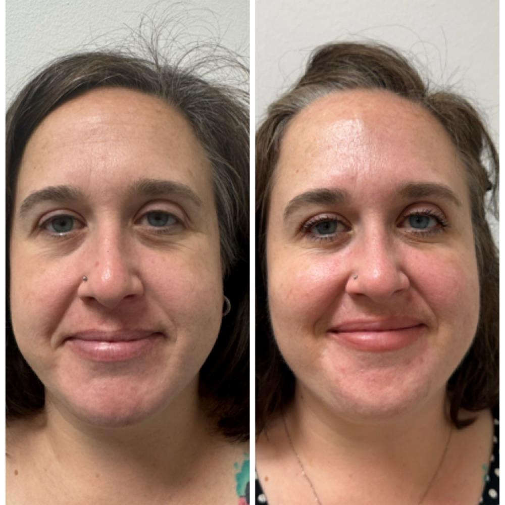 Facial Balancing at Cherished Aesthetics in Snellville, GA