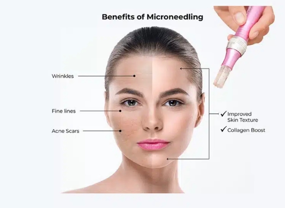 Microneedling Package Of  4