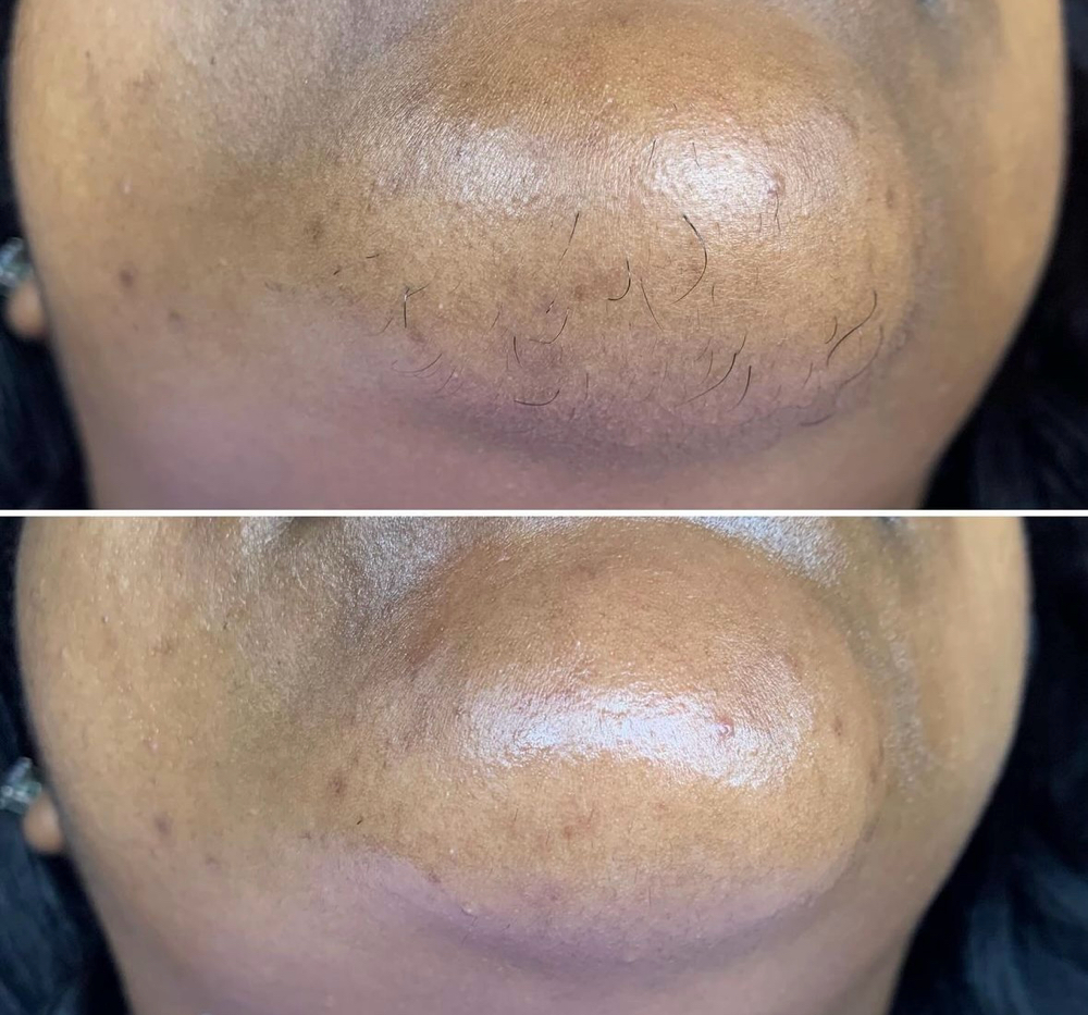 Chin Wax