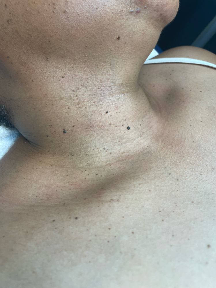 DPN SKin Tag Removal 11-30