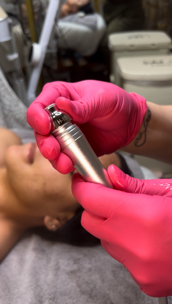 Microdermabrasion Face Only