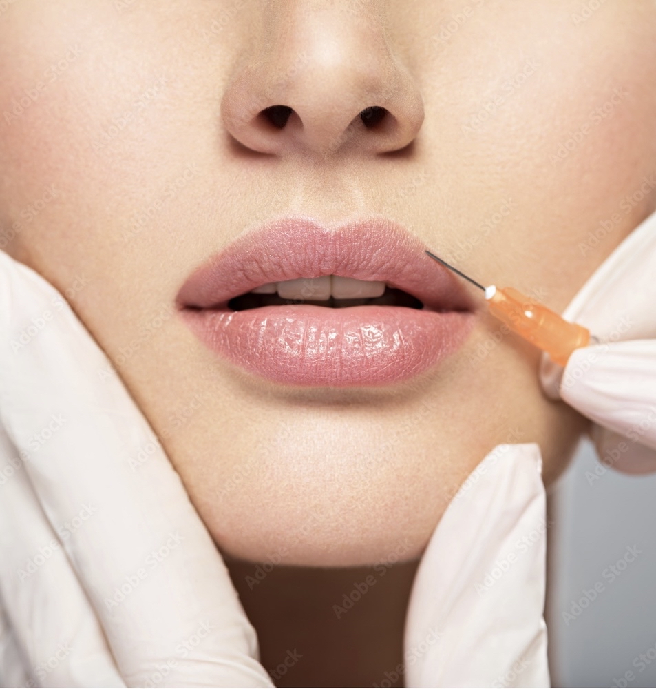 Lip Filler - Full Syringe