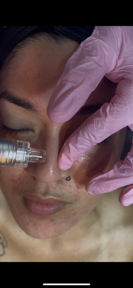 Hydrodermabrasion Add On at Skin Tender in Ventura, CA