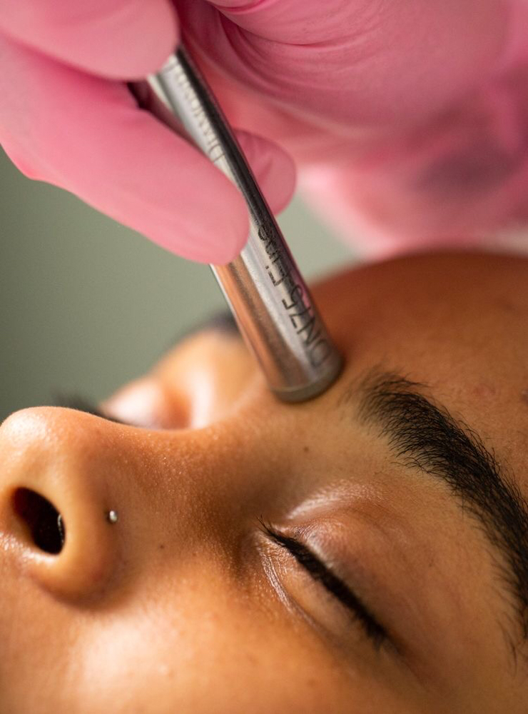 Microdermabrasion Facial