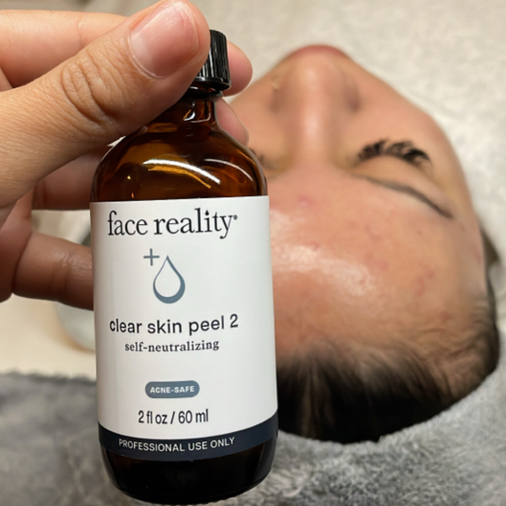 Acne Treatment & Check In at Alina Aesthetics in Cedar Park, TX
