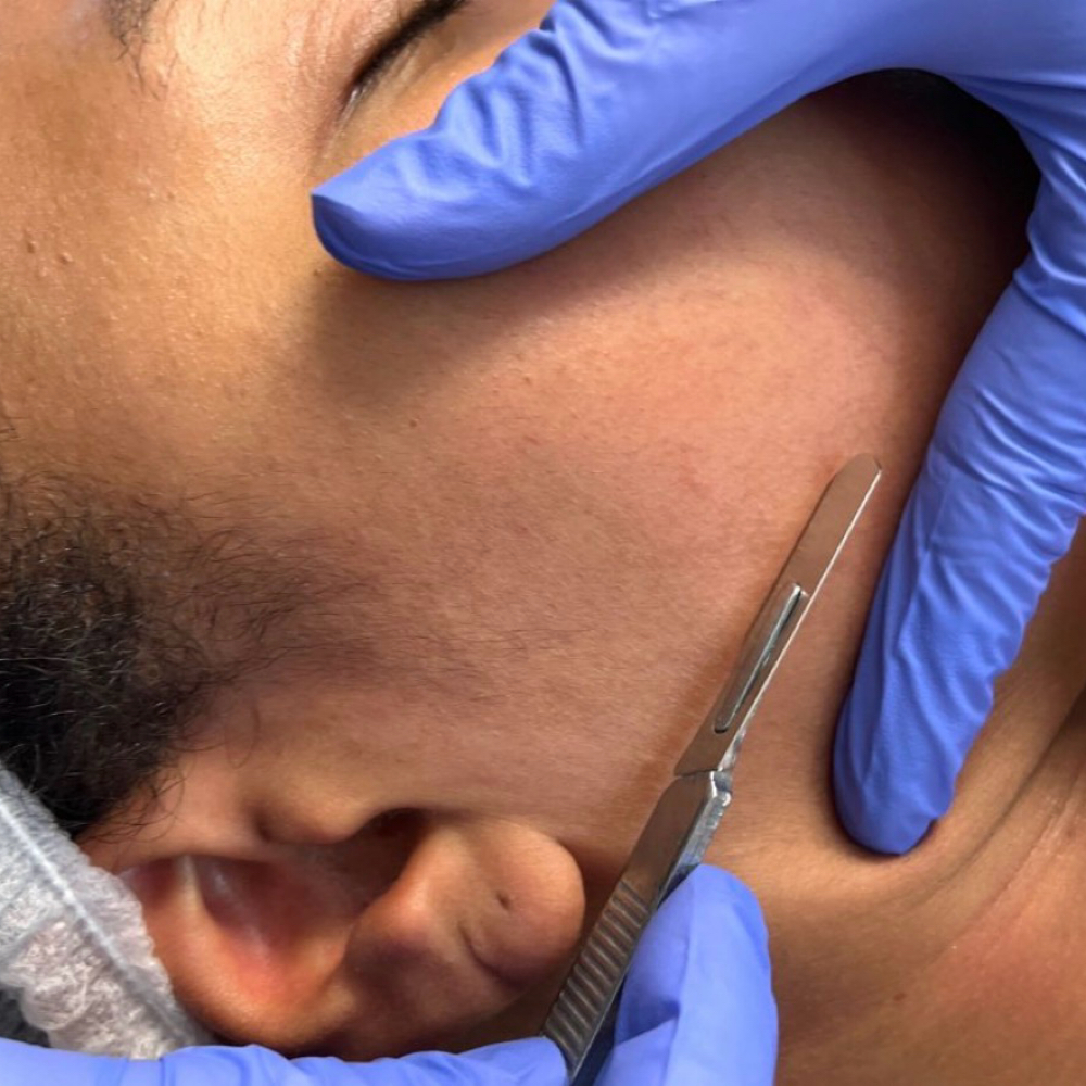 Dermaplaning facial at Rachel Kerr Esthetics in lynnwood, WA