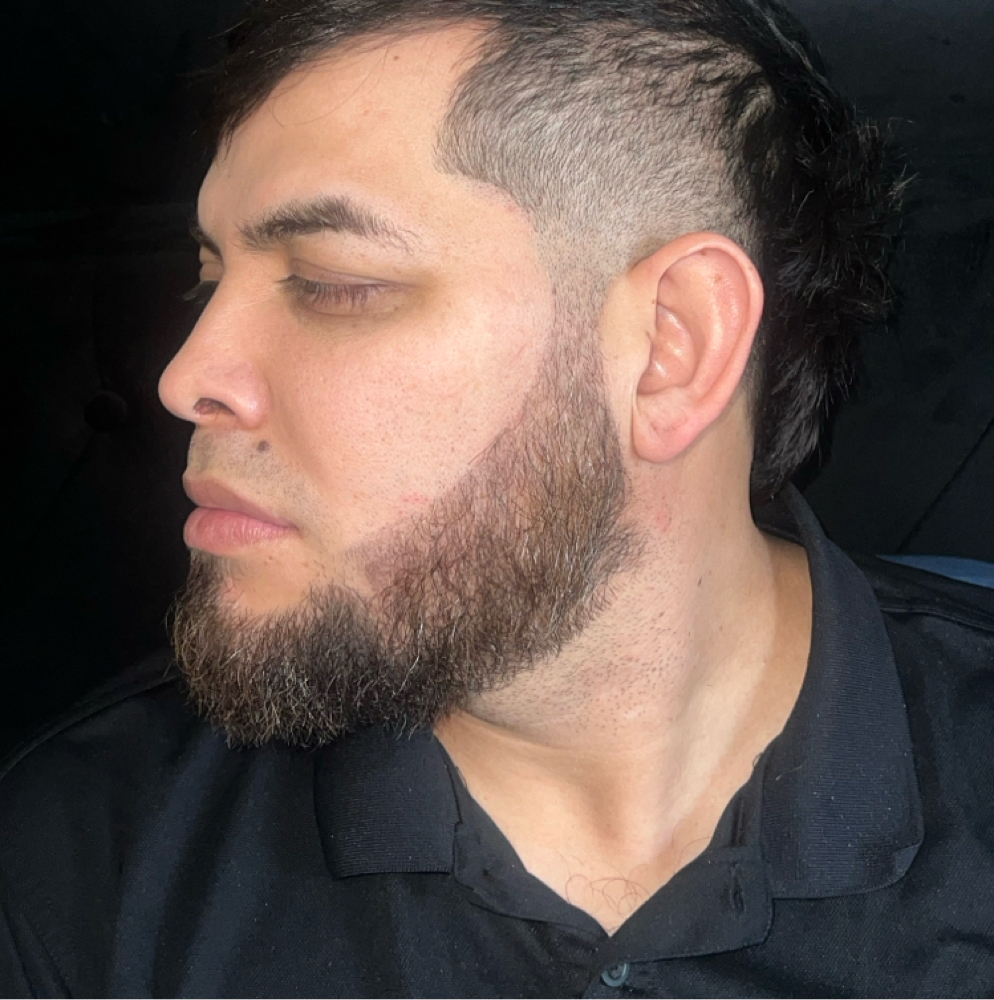🧔 MALE JAWLINE FILLER at Flawless Spa & Beauty in Fort Worth, TX