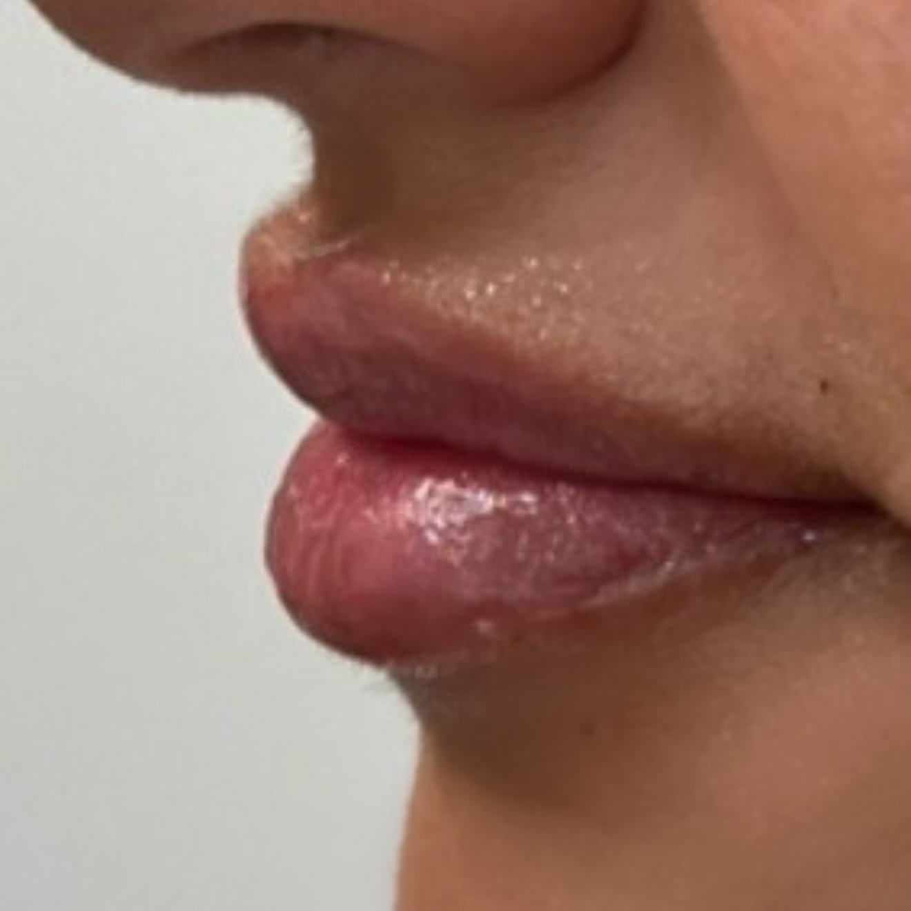 DERMAL FILLERS/ LIP FILLER at Merchaesthetics in Dallas, TX