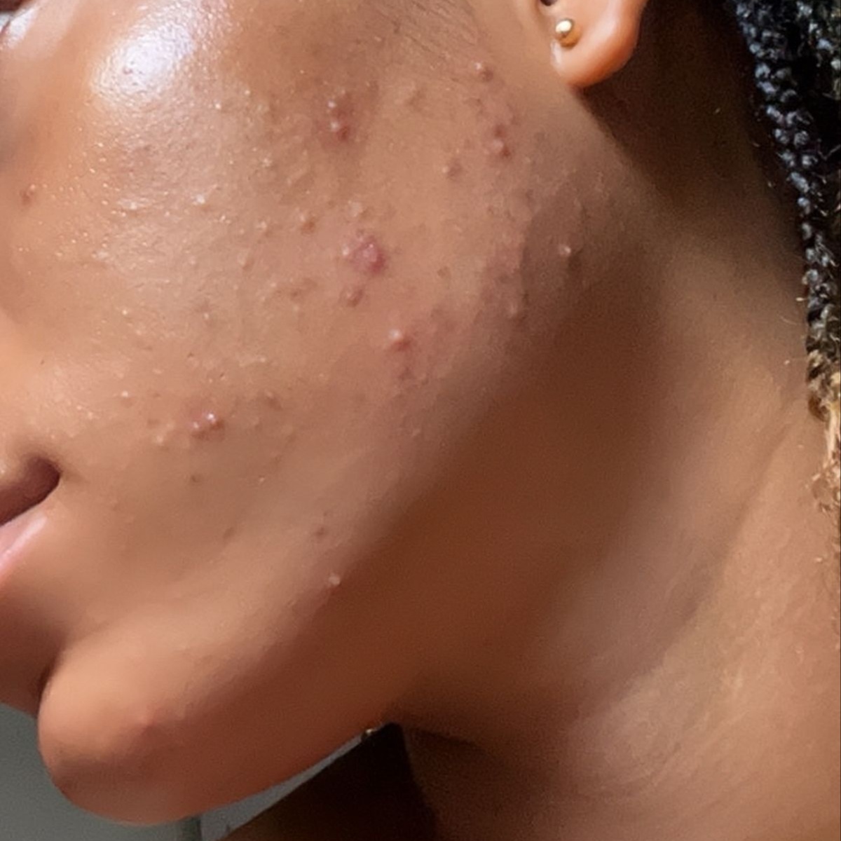 In-Spa Acne Consult at Kaiyani Esthetics in Nashville, TN