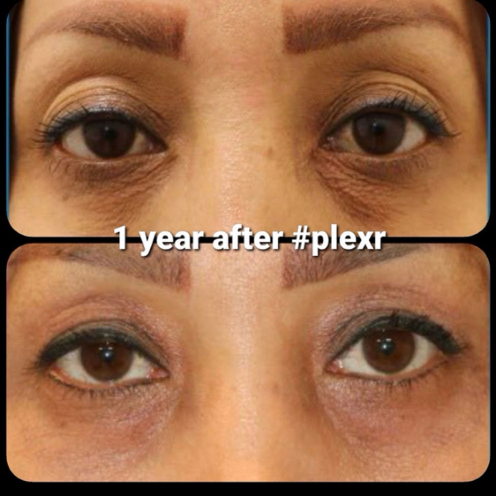 BYE BYE EYE BAGS Or HOODED EYES! at Plump Haus LA in Beverly Hills, CA