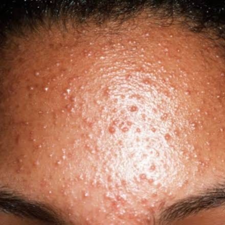 Folliculitis & Acne Therapy™ at Soluna Vee Spa in Colorado Springs, CO