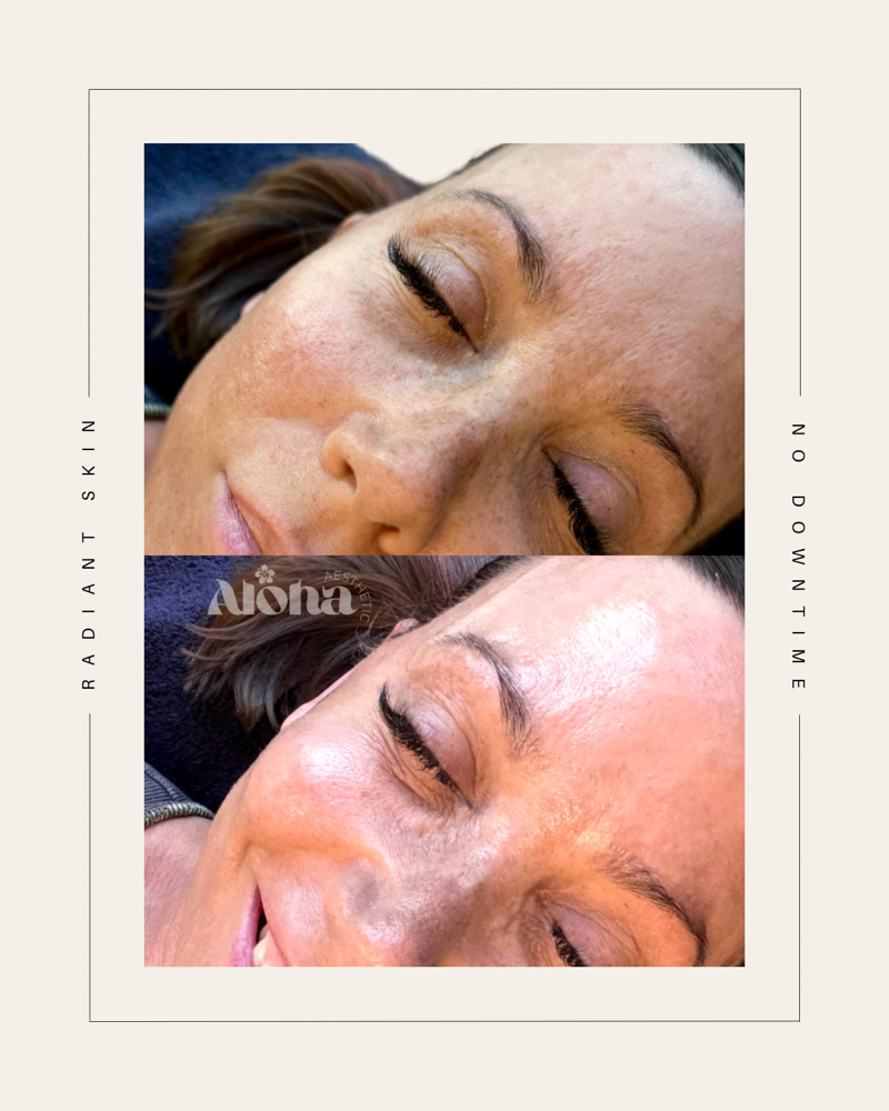 Dermaplane Treatment