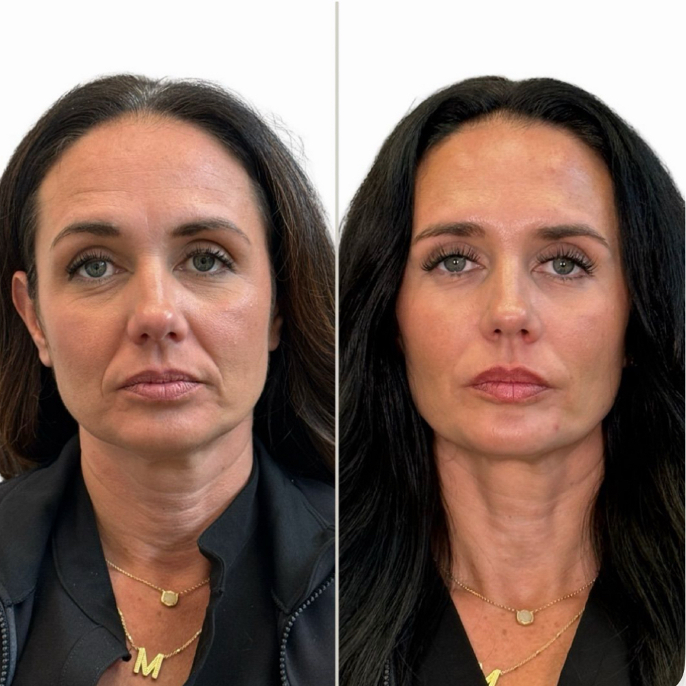✨MODEL PROMO BOTOX✨ at The Skin Room Med Spa in Marshall, TX