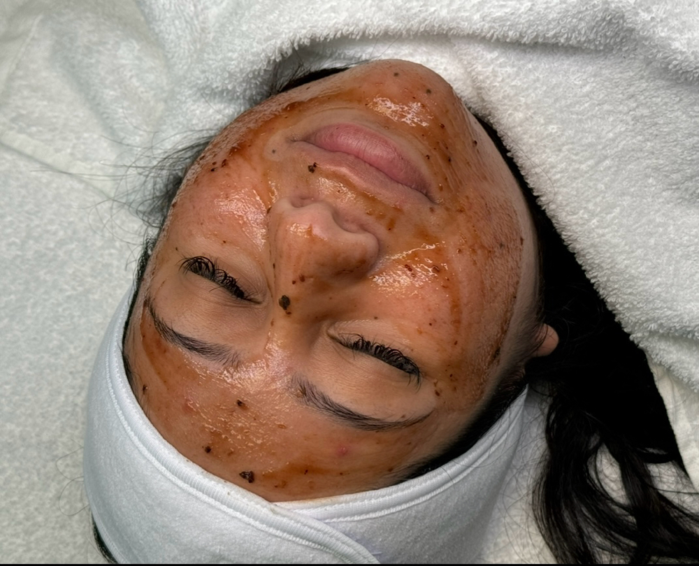 Enzyme Peel at Dreamy Eyes And Skin in Palm Springs, FL