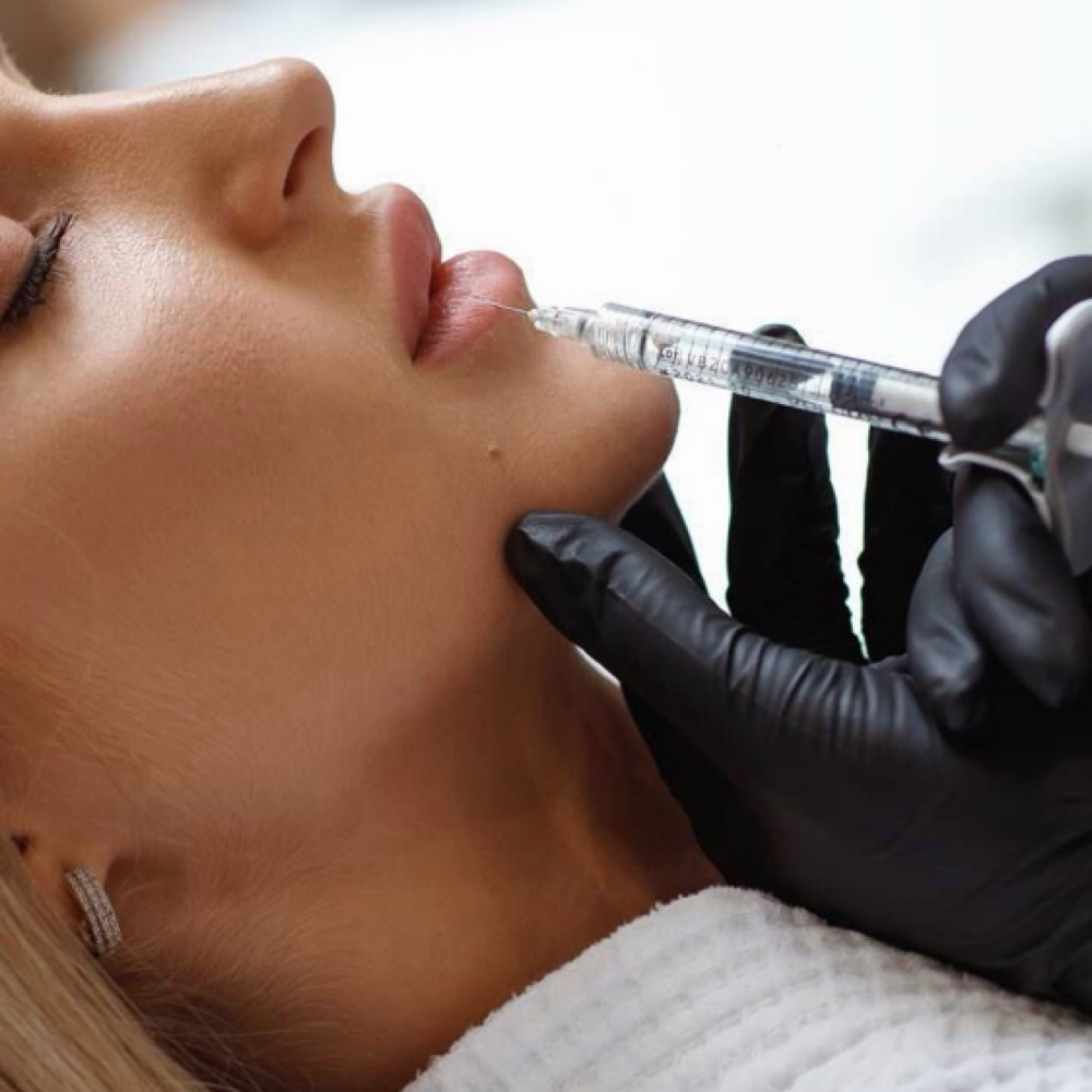 Lip Fillers/Rellenos De Labios1.0mL at Lumé Aesthetics in Pharr, TX