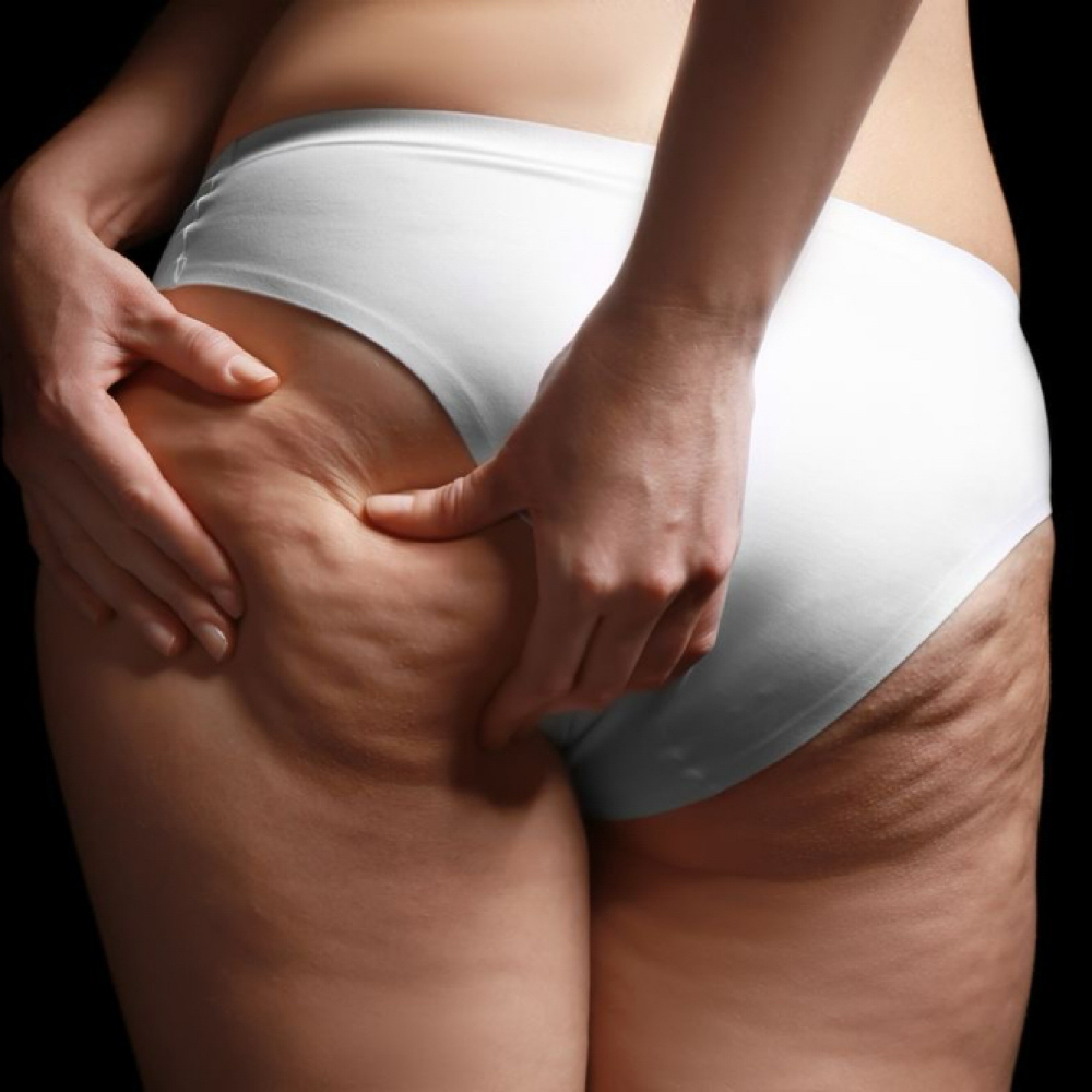 ALOE ANTI-CELLULITE COCOON