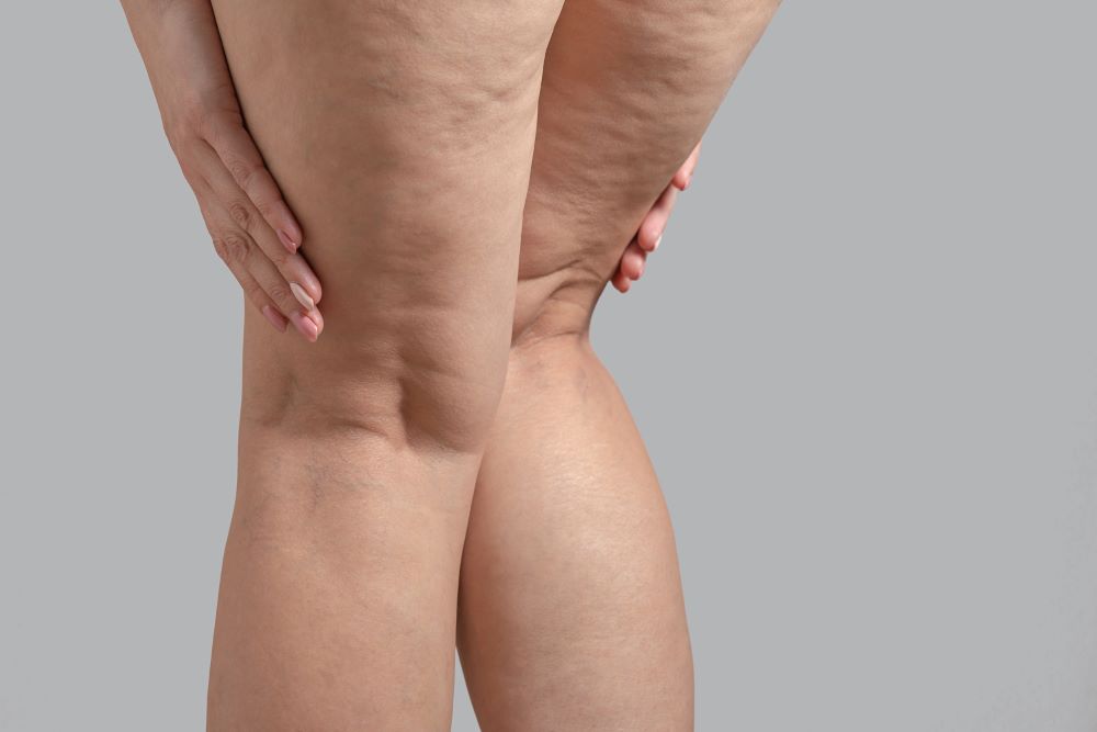 CELLULITE CONTROL   (PEFE)