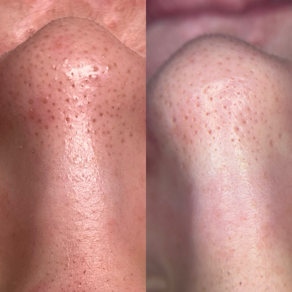 30 min Extraction Mini Facial