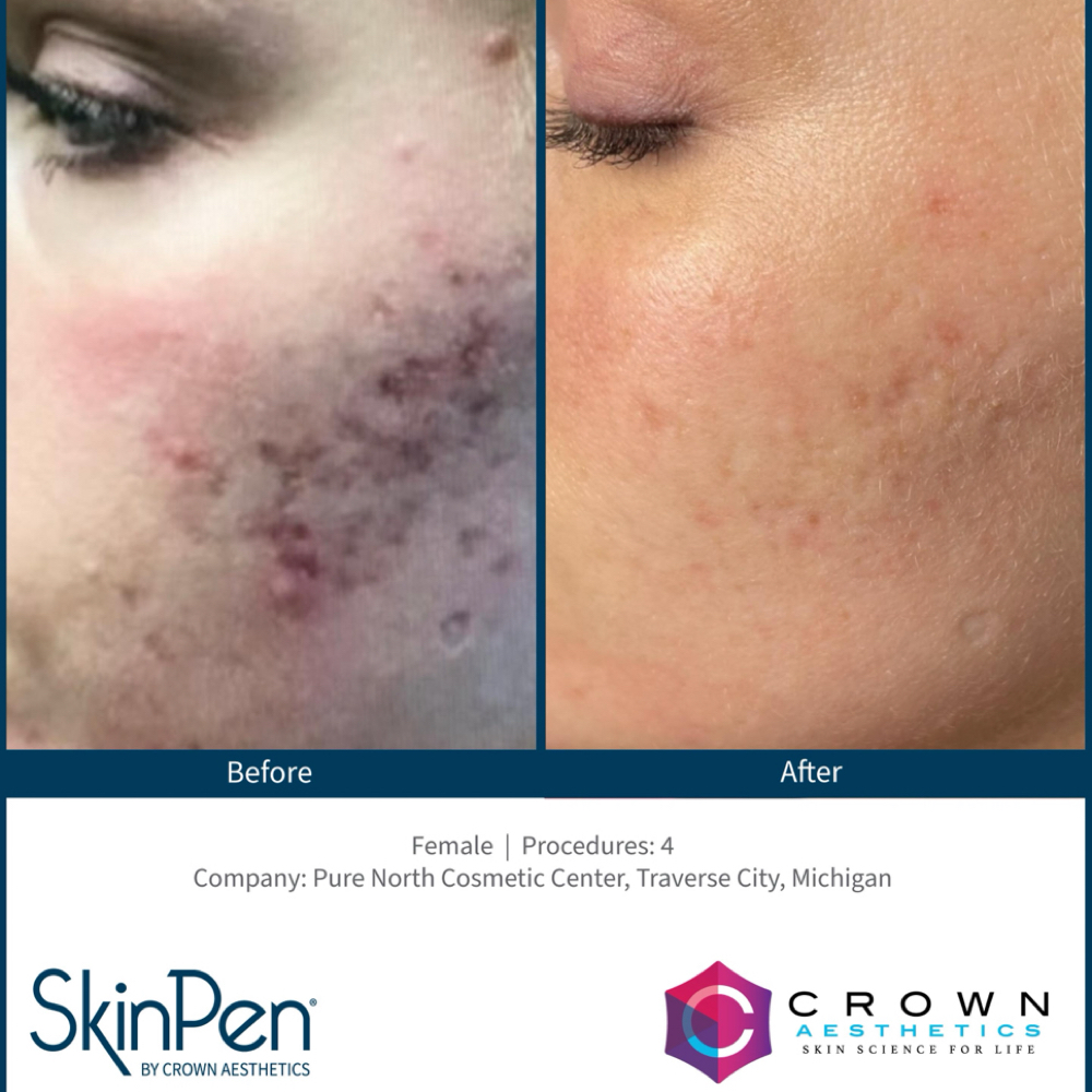 Microneedling (Single Session) at Rachel Kerr Esthetics in lynnwood, WA