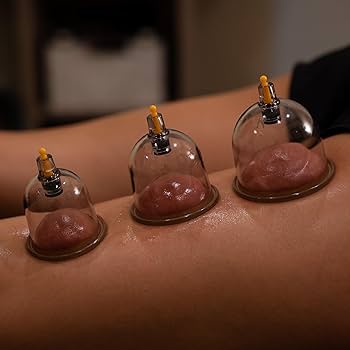 Cupping Therapy (ADD-ON ONLY)