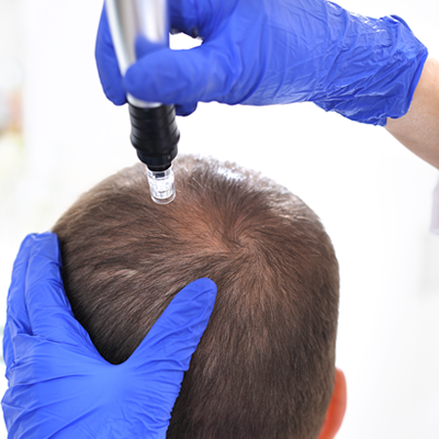 Revive Microneedling Hair Therapy