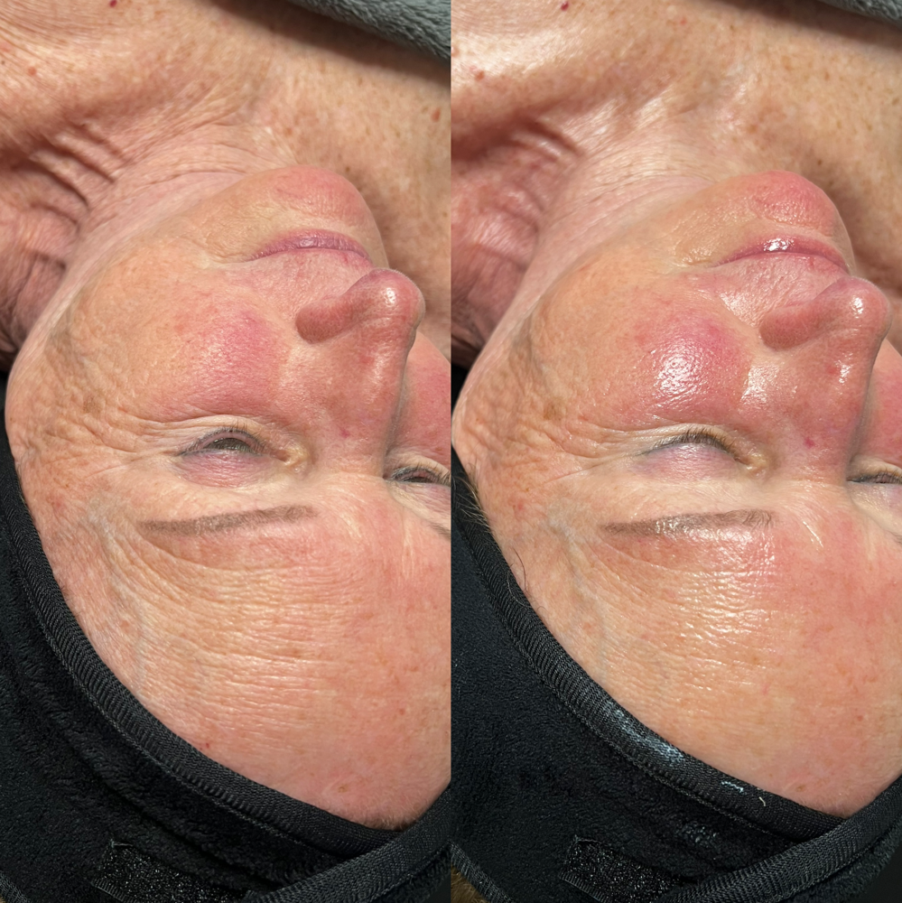 Nano Infusion Facial