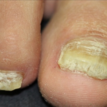 Stage II- RN- Medical Pedicure