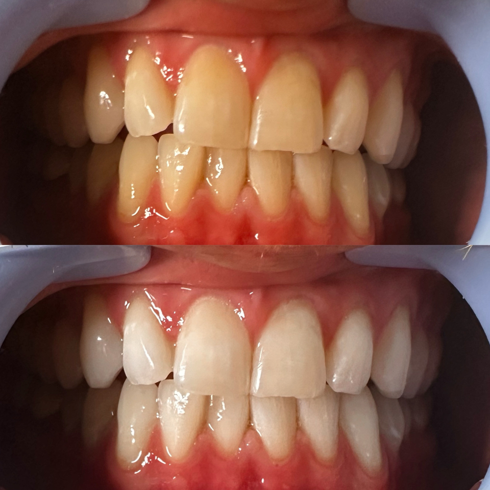 Laser Teeth Whitening