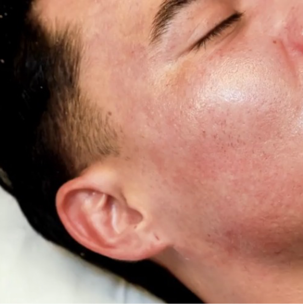 GlowExfo Treatment at GlowDerm Clinic in San Jose, CA